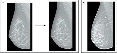 Clinical-radiomic models based on digital breast tomosynthesis images: a preliminary investigation of a predictive tool for cancer diagnosis